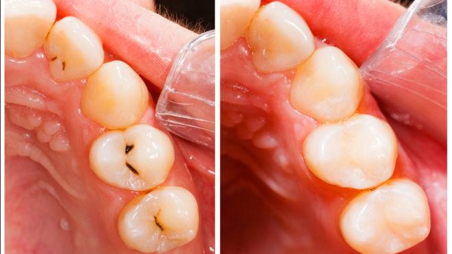 Composite Tooth Colored Fillings